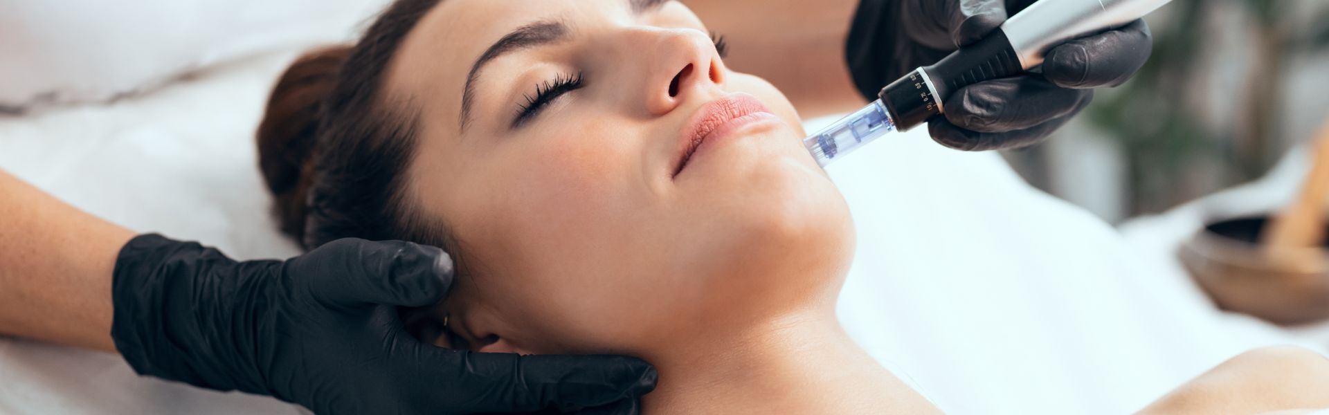 Microneedle Dermapen: estimulación profunda para tu piel thumbnail